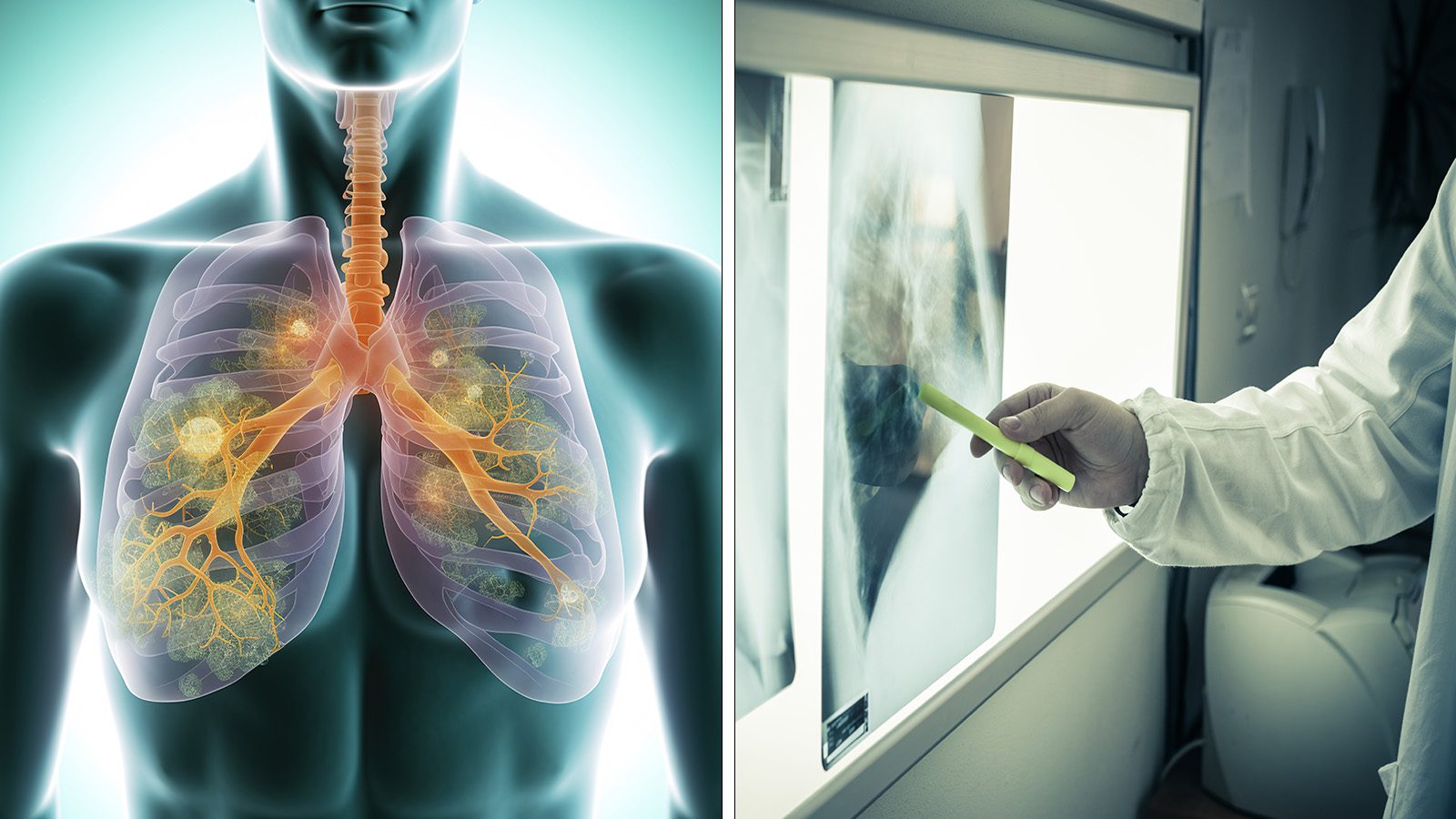 10 Silent Symptoms of Lung Cancer to Never Ignore