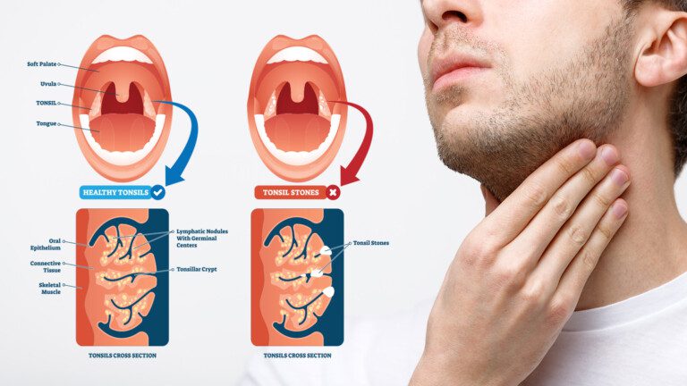 tonsil stones