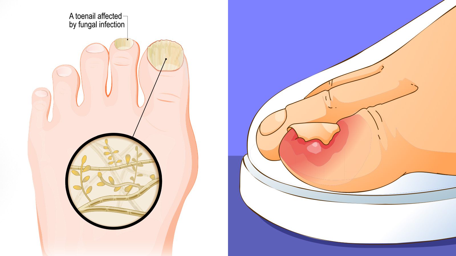 Dermatologists Explain the Causes of Toenail Infections (and How to Fix It)