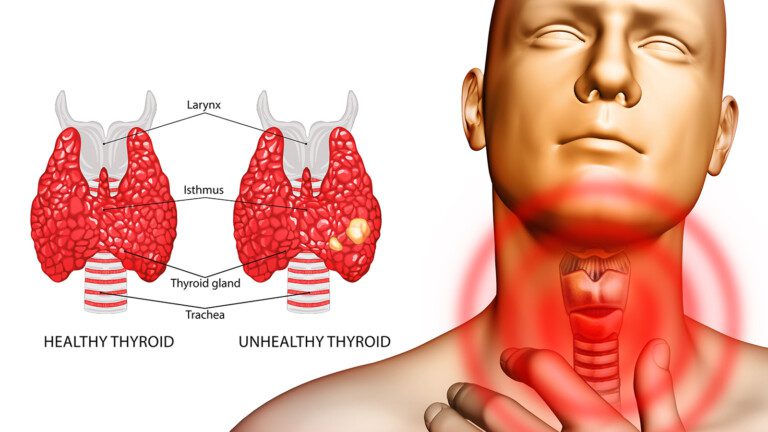 thyroid condition health signs