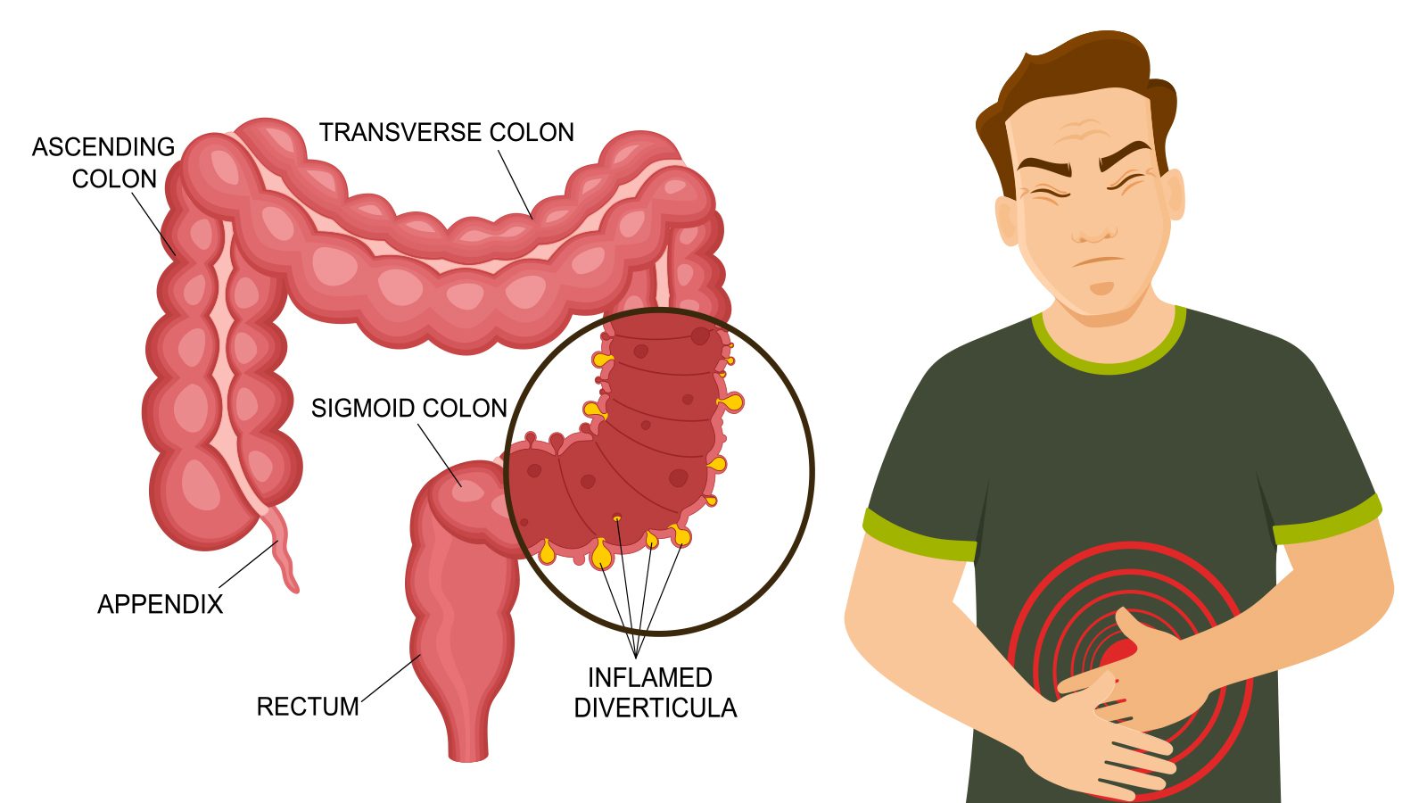 10 Signs of Diverticulitis (and What To Do)