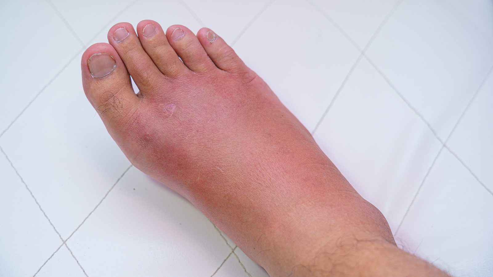 swollen feet swelling