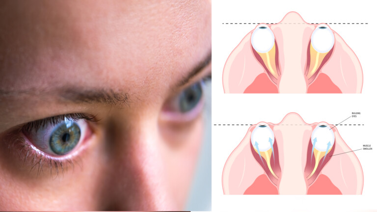 thyroid eye disease